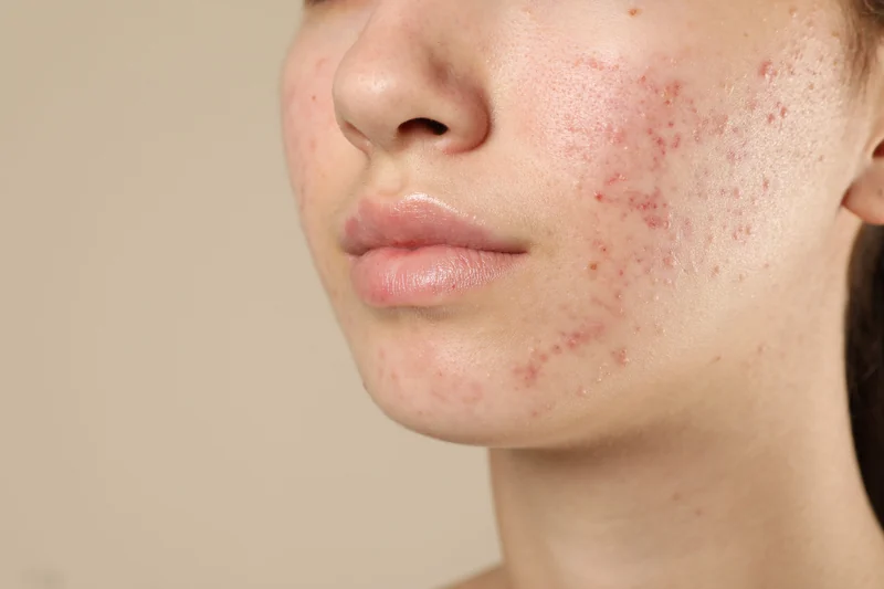 Acne