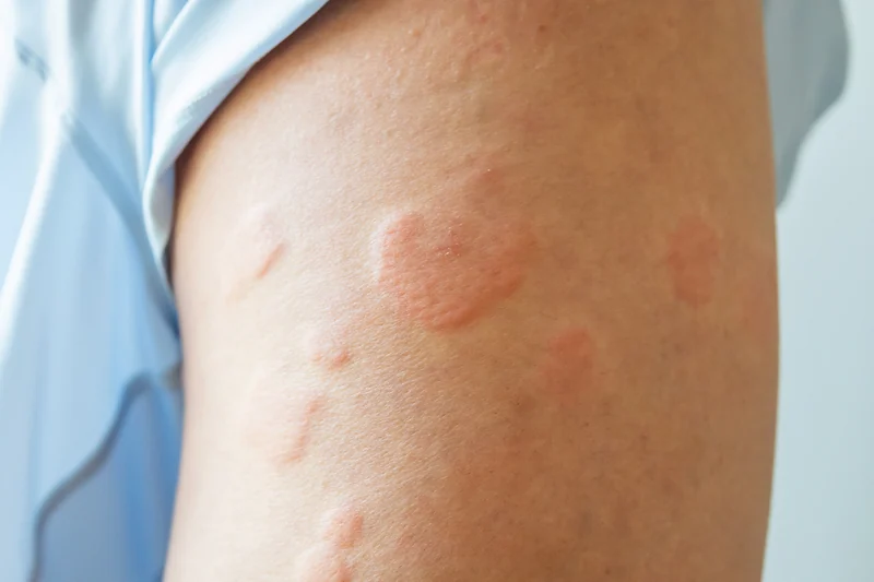 Fungal Infections (Tinea, Candida)