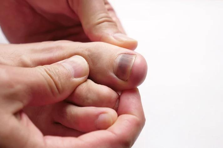 Nail Diseases