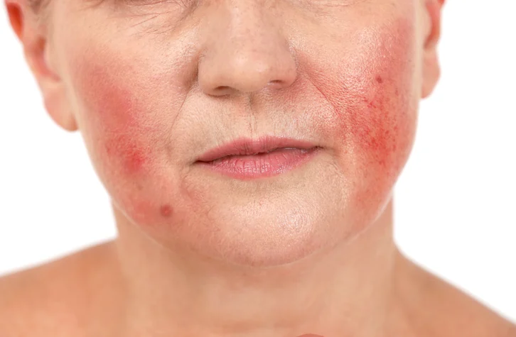 Rosacea