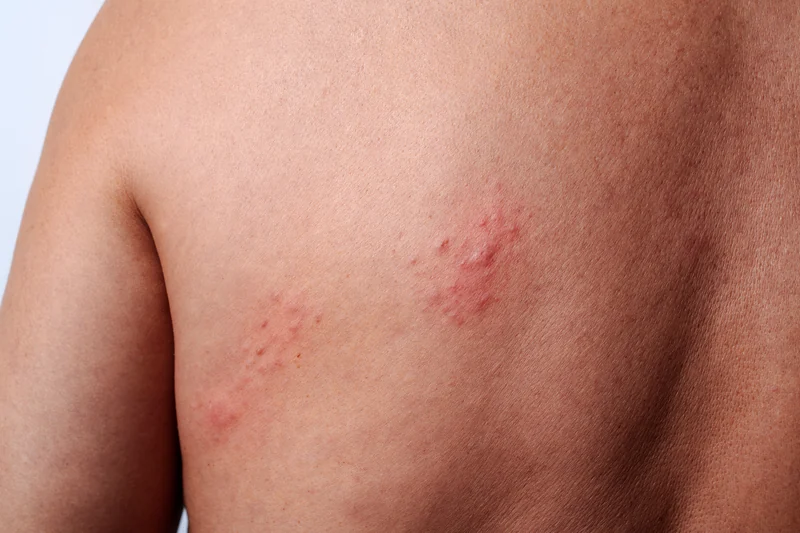 Shingles (Herpes Zoster)