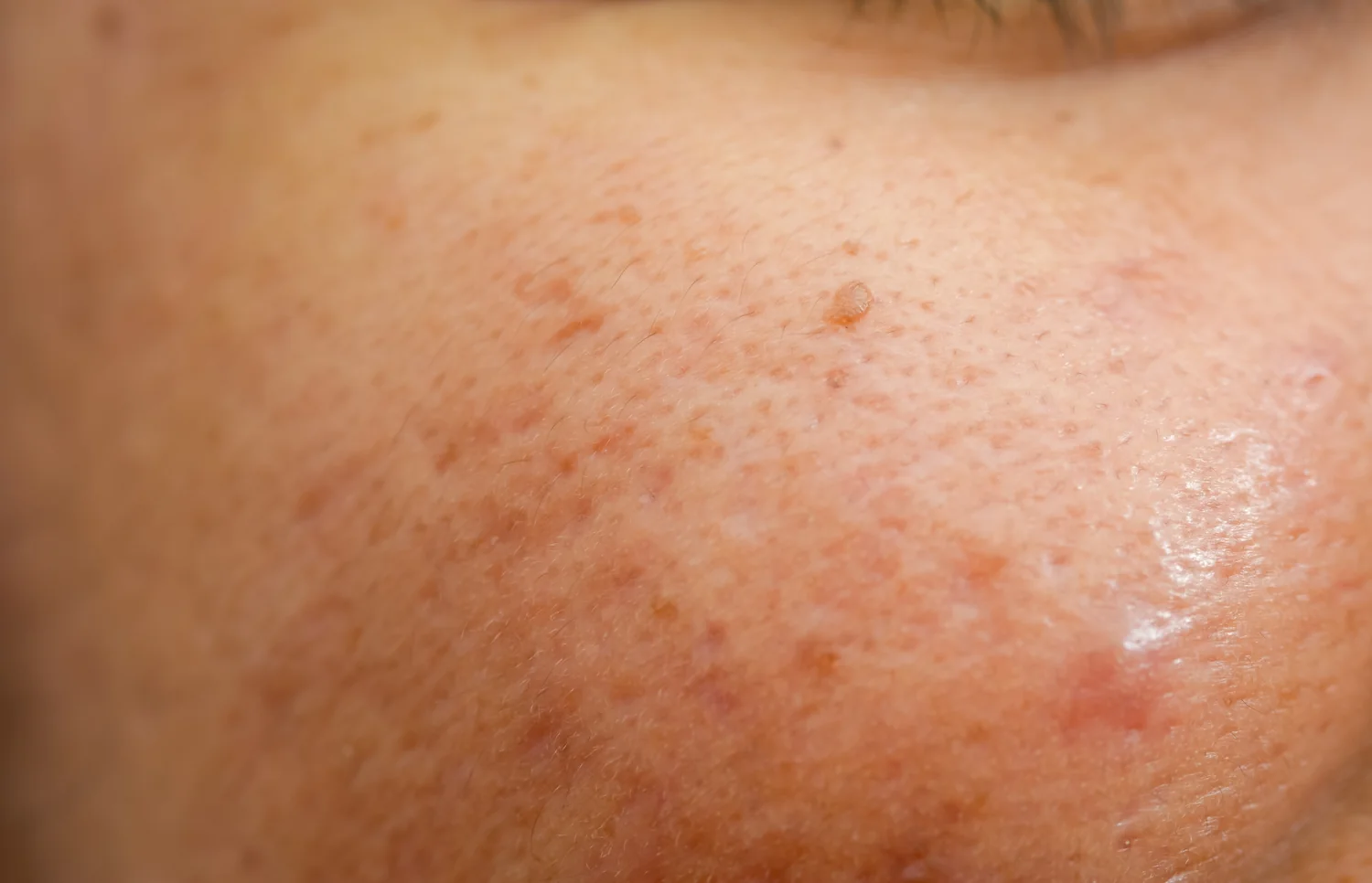 Skin Pigmentation (Dark Spots)