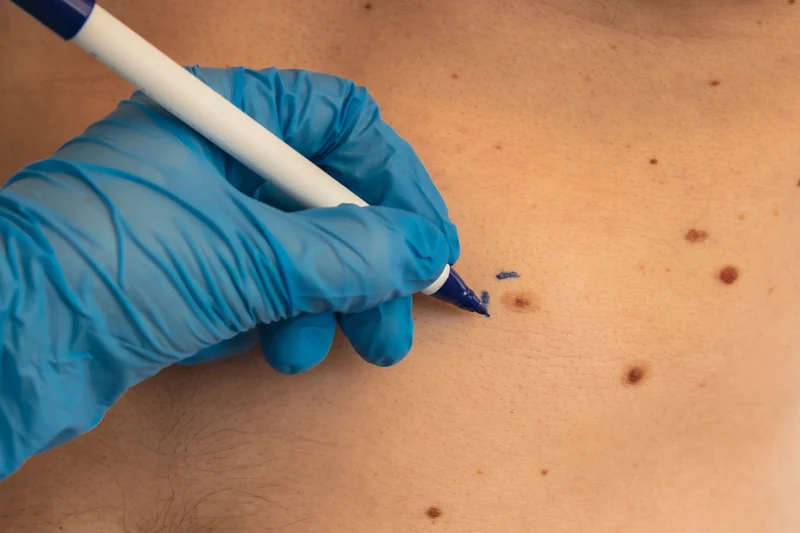Early Detection and Monitoring of Skin Cancer