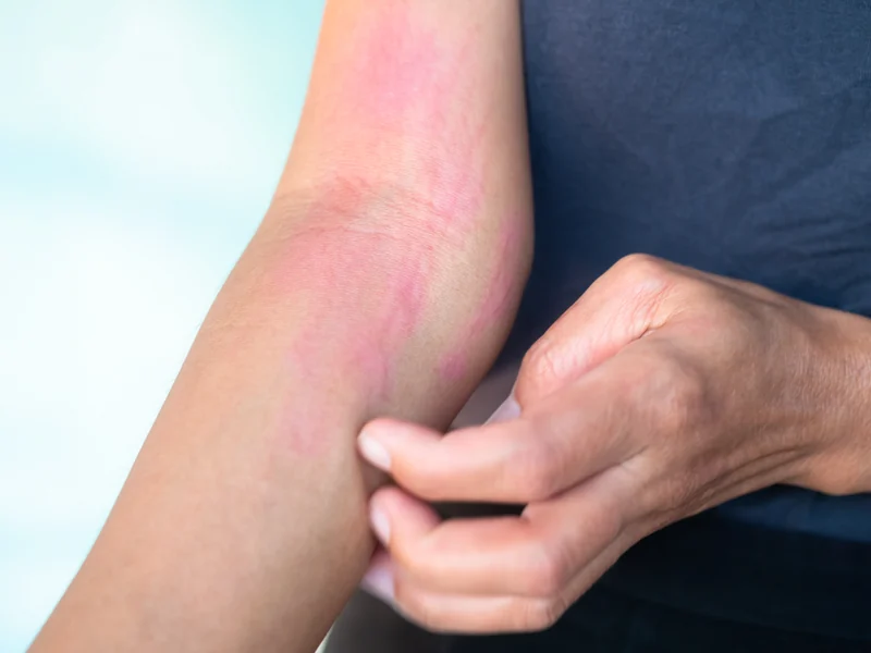 Urticaria (Hives)