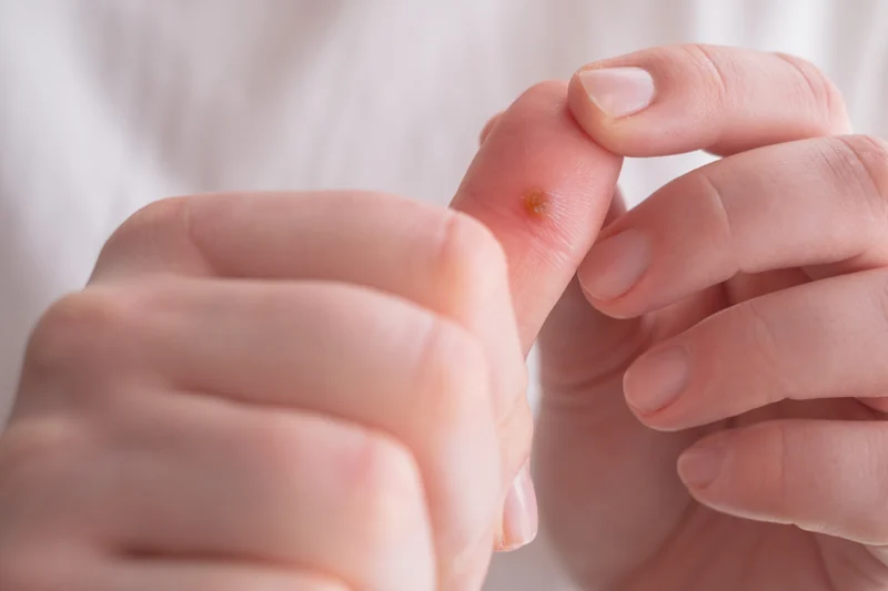 Wart Treatment